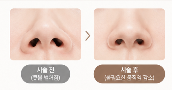 코 보톡스 병원 추천, 효과 있을까? 1주일 차 리얼 후기와 통증